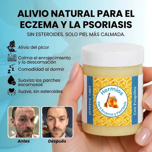 Bálsamo Reparador Para El Eccema Y La Psoriasis