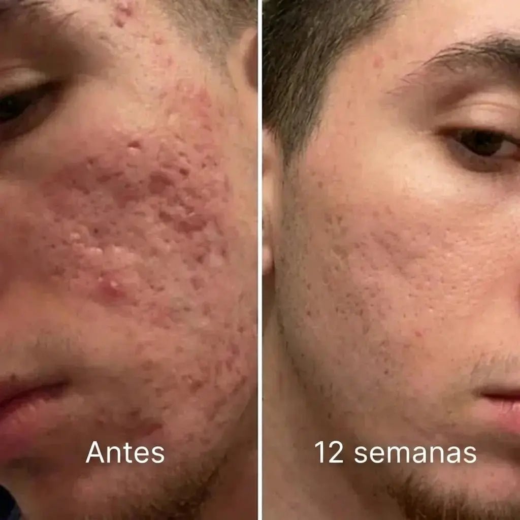 Barrera de reparación invisible para cicatrices de acné