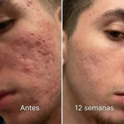 Barrera de reparación invisible para cicatrices de acné