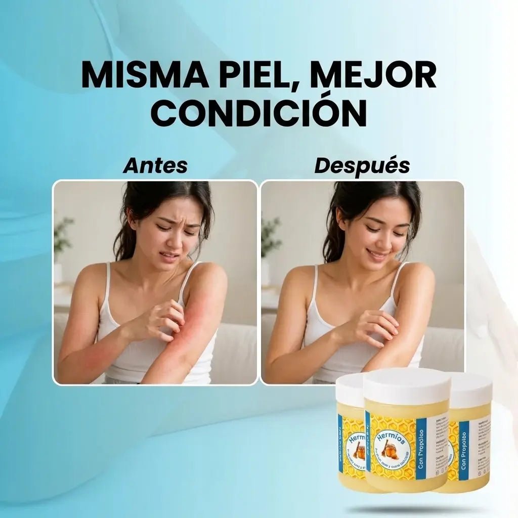 Bálsamo Reparador Para El Eccema Y La Psoriasis