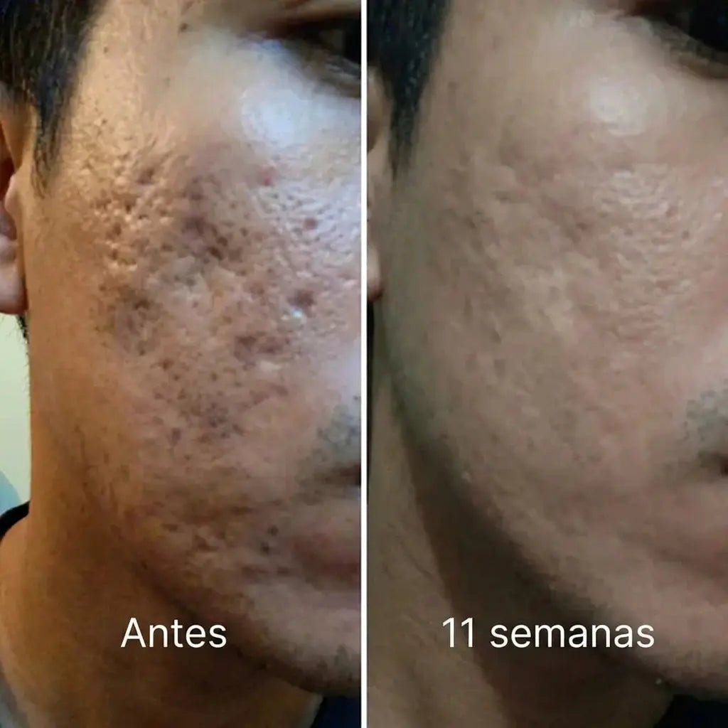 Barrera de reparación invisible para cicatrices de acné