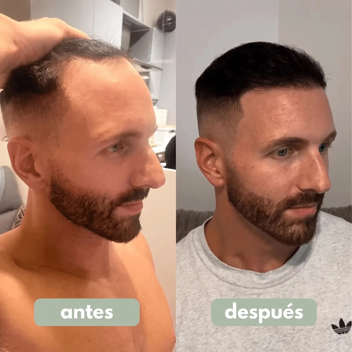 Suero Para El Crecimiento Del Cabello
