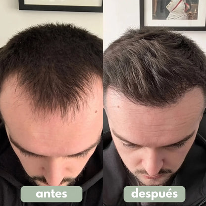 Suero Para El Crecimiento Del Cabello