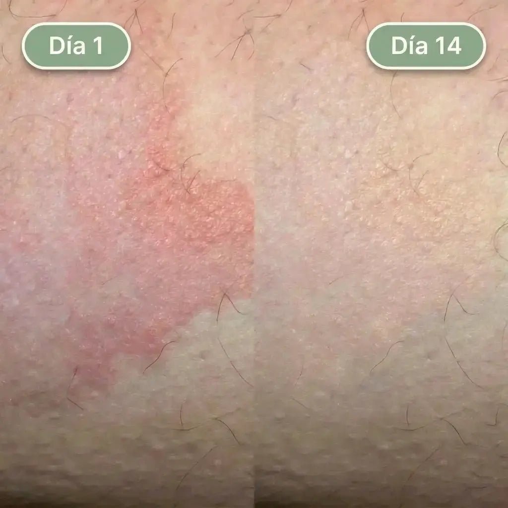 Crema Para Aliviar La Tiña Inguinal