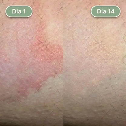 Crema Para Aliviar La Tiña Inguinal